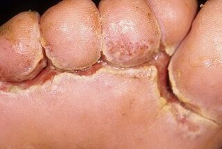 Síntomas do fungo das unhas