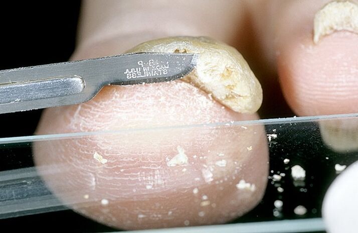 Raspado de unhas para diagnosticar fungos