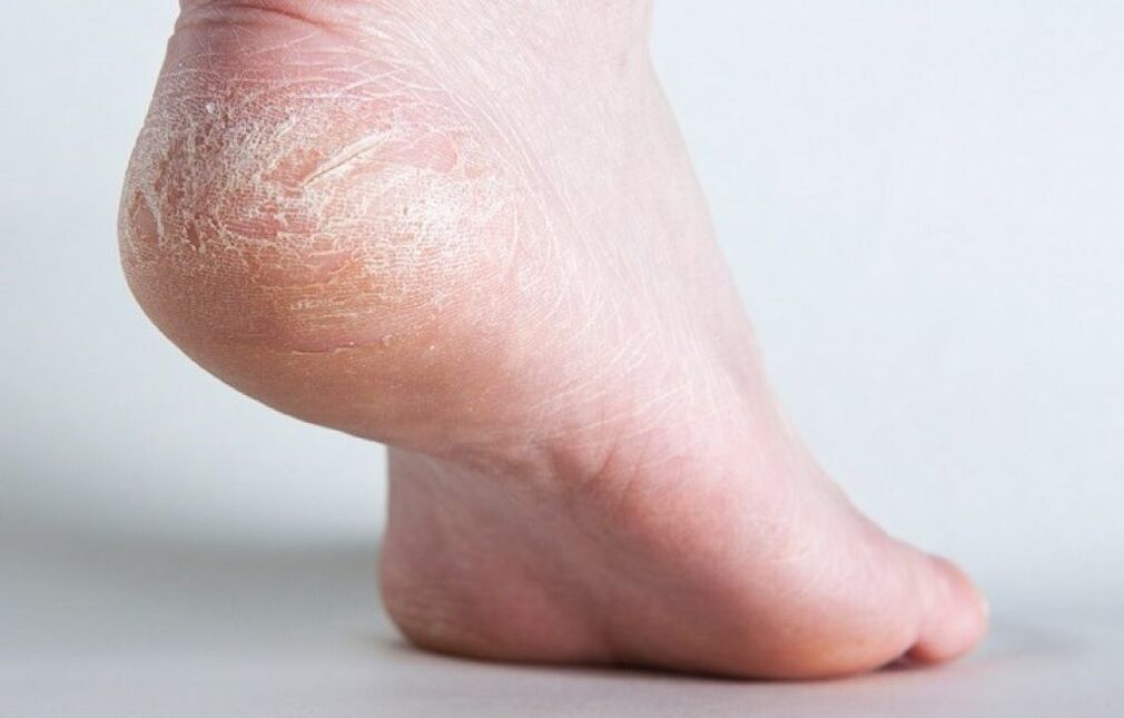 como tratar o fungo da pel na perna
