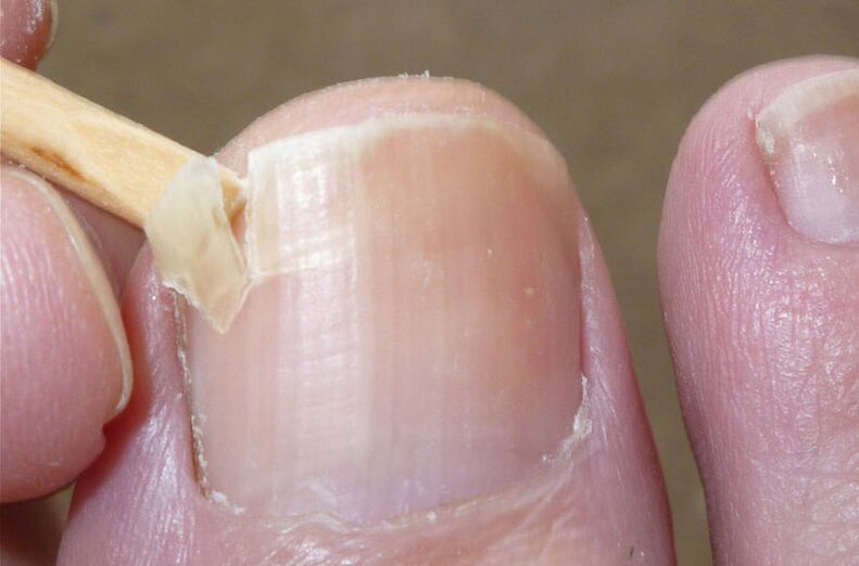 As uñas danadas son un factor de risco para unha infección por fungos