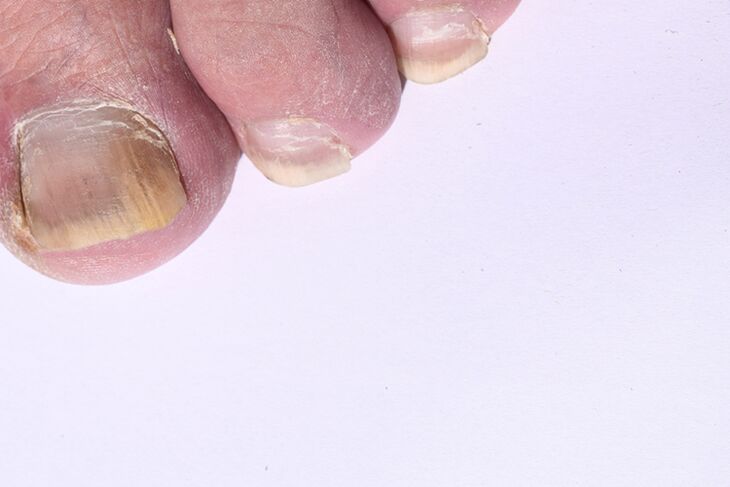 A fase inicial da micose das uñas nas pernas