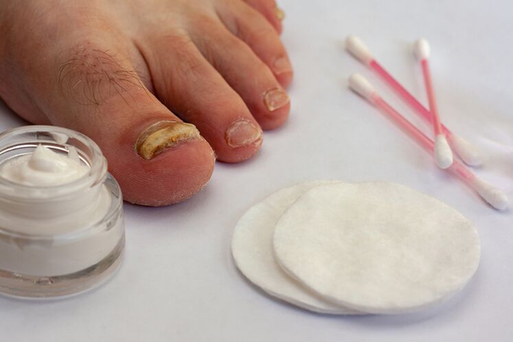 Tratamento do cogomelo de dedo con crema do cogomelo