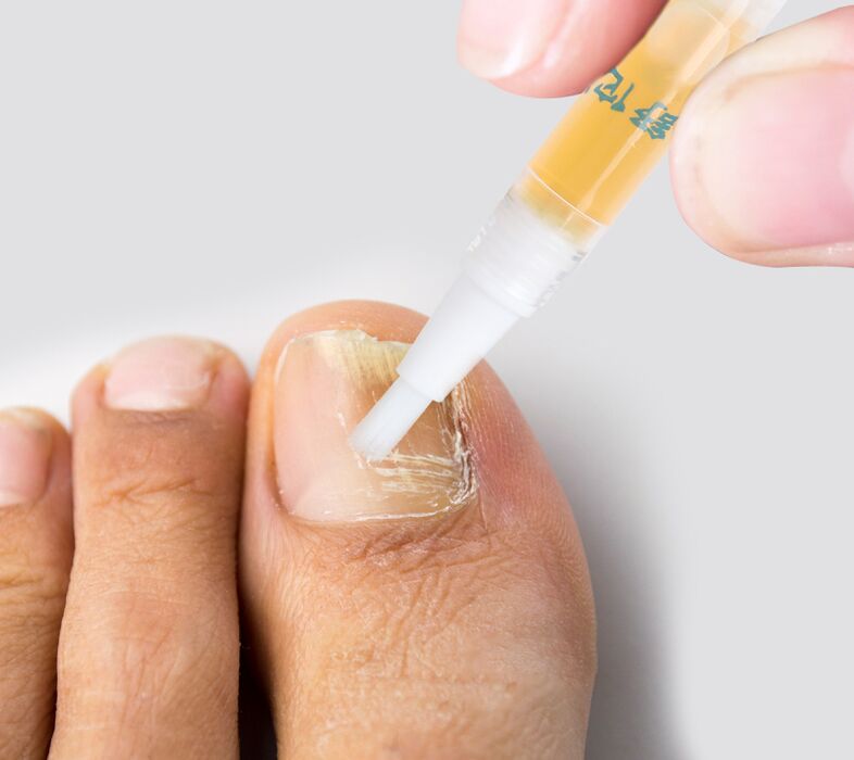 Líquido para fungos nas unhas dos pés