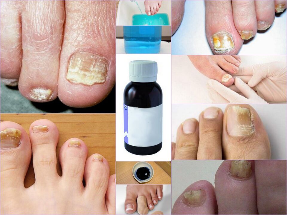 Medicamento para fungos nas unhas dos pés