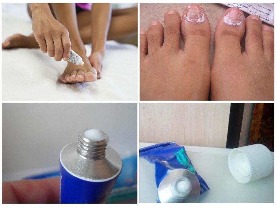 preparados farmacéuticos eficaces contra o fungo das unhas