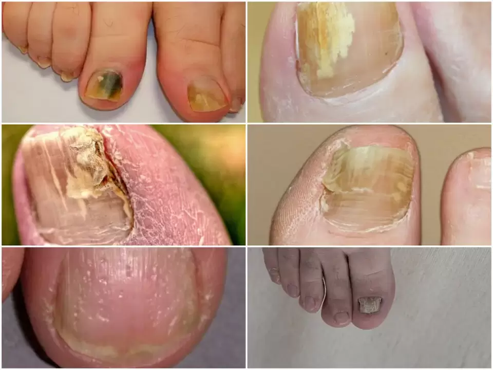 Síntomas de onicomicose - cambios na cor e estrutura das uñas