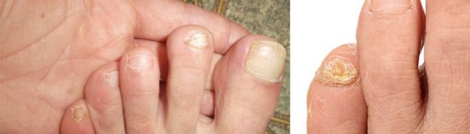 Foto de manifestacións fúngicas nas uñas dos pés