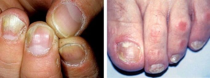 Manifestacións dunha infección por fungos nas uñas