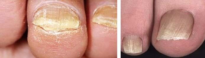 Danos nas uñas por infección por fungos
