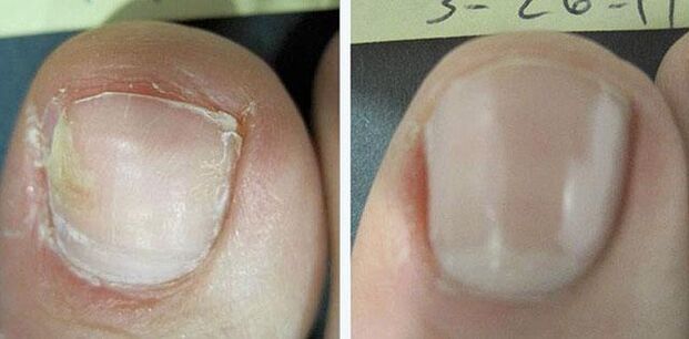 antes e despois do tratamento para fungos nas unhas