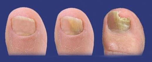 Fases do desenvolvemento do fungo nas uñas dos pés