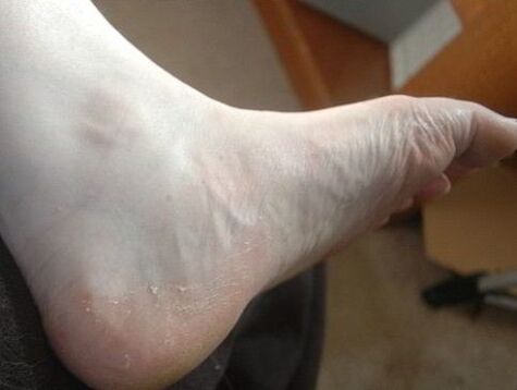 Peeling do pé da perna como sinal dunha infección por fungos