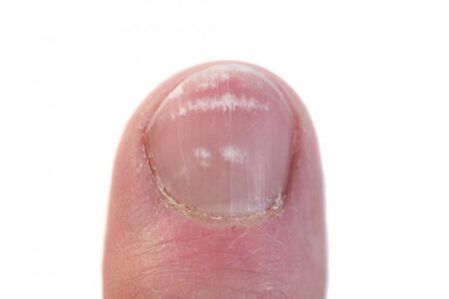 a fase inicial da infección por fungos nas uñas